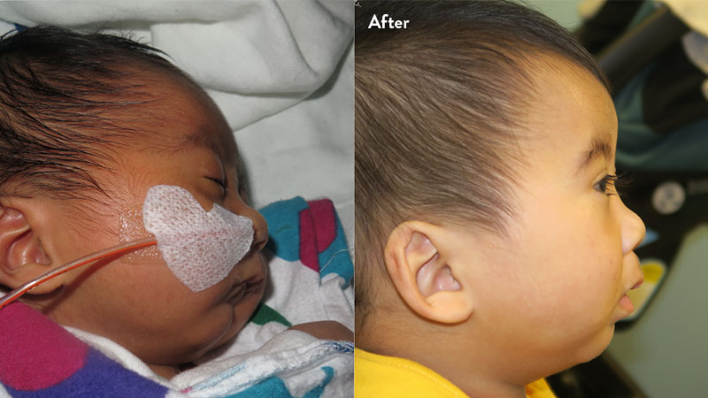 Before and after of infant with orthodontic airway plate treatment