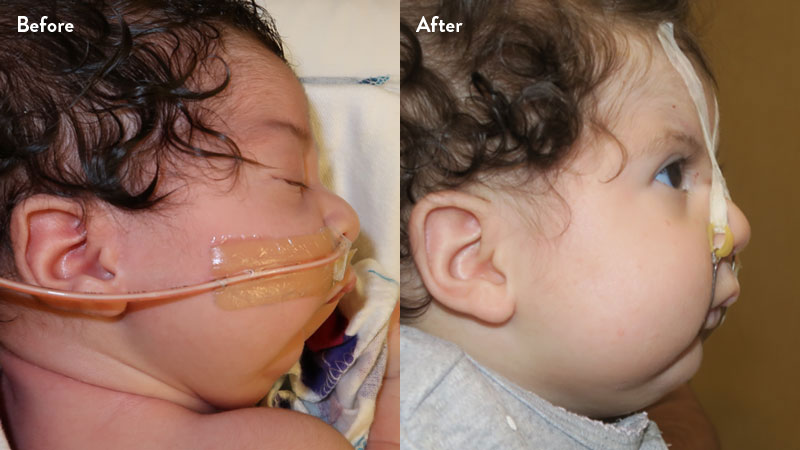 Before and after of infant with orthodontic airway plate treatment