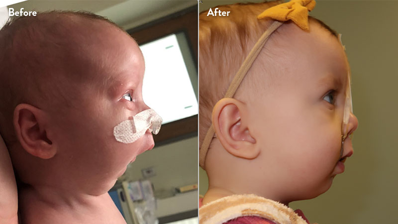 Before and after of infant with orthodontic airway plate treatment