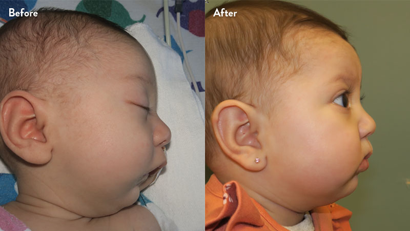 Before and after of infant with orthodontic airway plate treatment